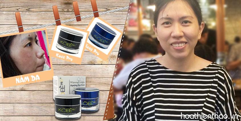 Bà mẹ 2 con tự tin về hạnh phúc gia đình sau khi trị nám thành công