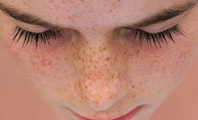 Cách phân biệt giữa nám da và tàn nhang