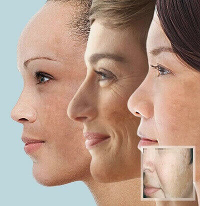 Cách phân biệt giữa nám da và tàn nhang