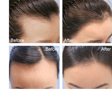 Trị rụng tóc với vỏ bưởi hiệu quả trong 1 tuần