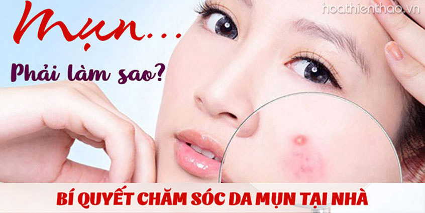 Cách chăm sóc da mụn tại nhà hiệu quá nhất