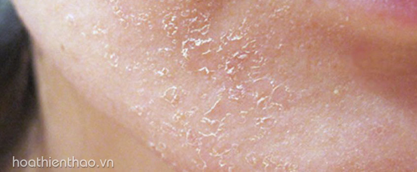 Da bạn sẽ có dấu hiệu ửng đỏ, bong tróc sau khi điều trị với tia laser