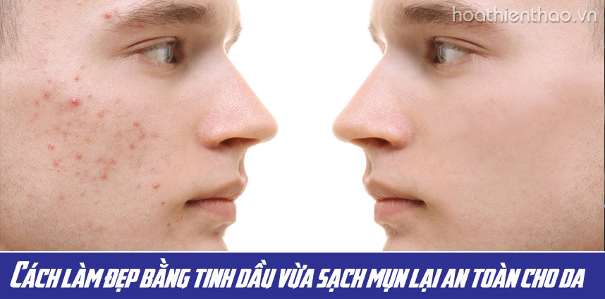 Cách làm đẹp bằng tinh dầu vừa sạch mụn lại an toàn cho da - Hoa Thiên Thảo