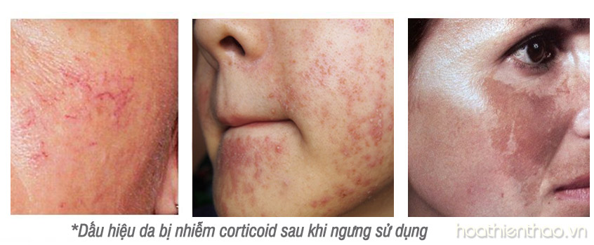 Cách phục hồi da và dấu hiệu da bị nhiễm Corticoid