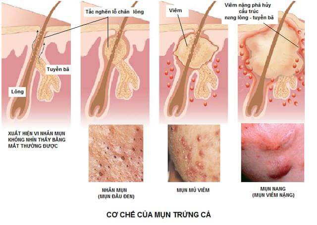 Cách trị mụn trứng cá hiệu quả nhanh