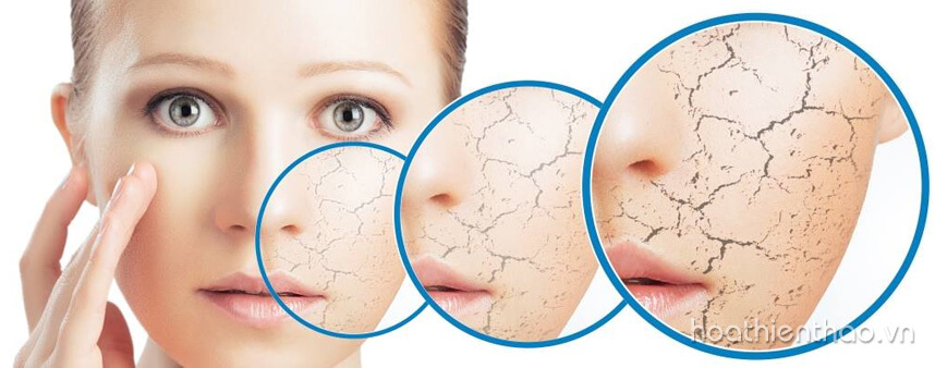 Chăm sóc da mùa Đông như thế nào - Hoa Thiên Thảo