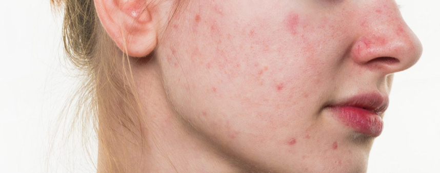 Chăm sóc da mùa Đông như thế nào - Hoa Thiên Thảo