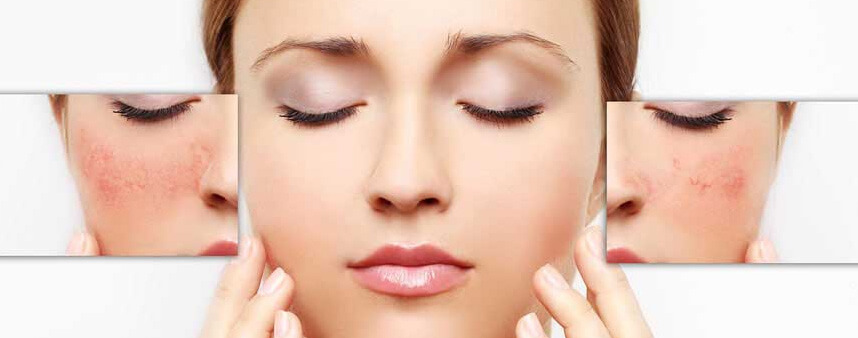 Chăm sóc da mùa Đông như thế nào - Hoa Thiên Thảo