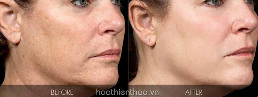 Chống lão hoá da hiệu quả với Retinol