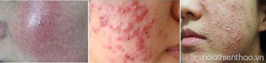 Sử dụng sai mỹ phẩm sẽ khiến da dị ứng, bong tróc, nổi nhiều mụn