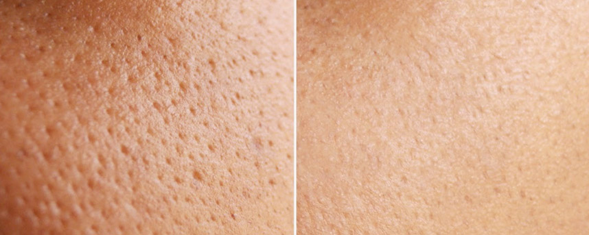Đẹp da với đá lạnh không phải ai cũng biết - Hoa Thiên Thảo