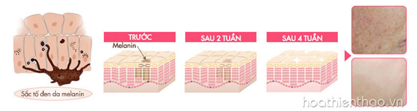 Phái đẹp đánh bại nám da nhờ Koee Pro