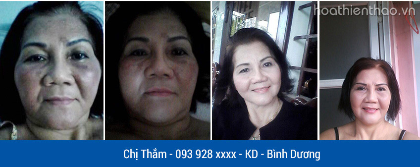 Phái đẹp đánh bại nám da nhờ Koee Pro