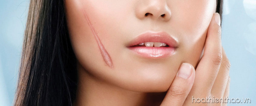 Làm thế nào để xóa mờ sẹo nhanh?