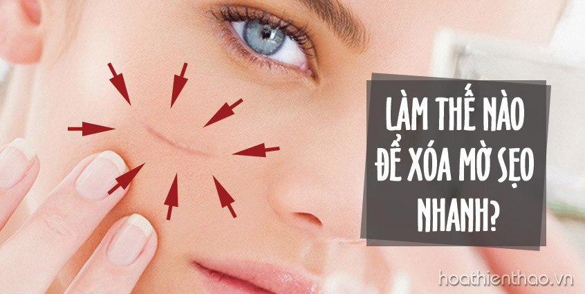 Làm thế nào để xóa mờ sẹo nhanh?
