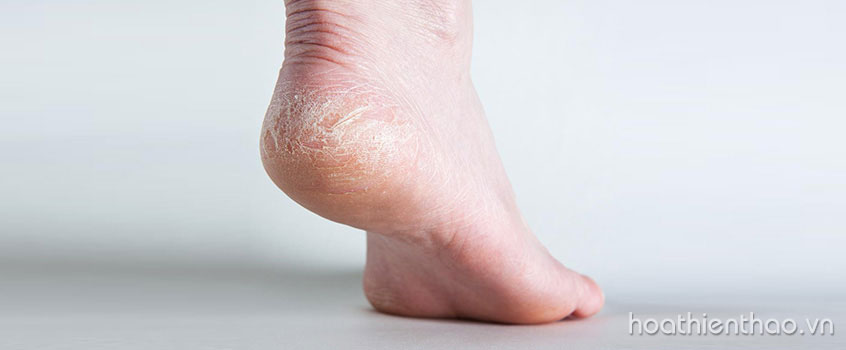 Mẹo trị nứt gót chân hiệu quả tại nhà