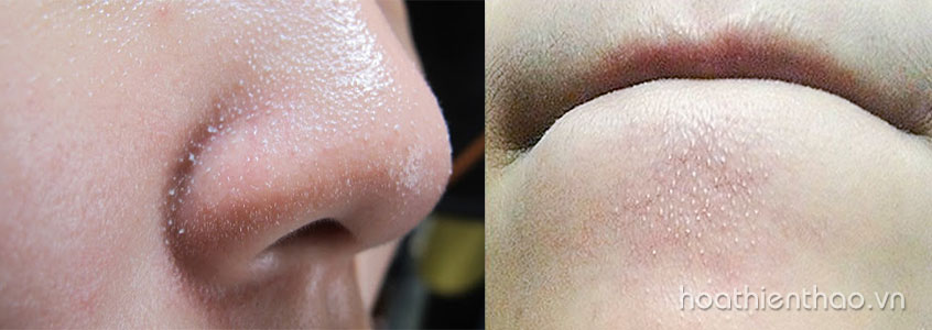 Mụn cám thường hình thành ở mũi và 2 bên má
