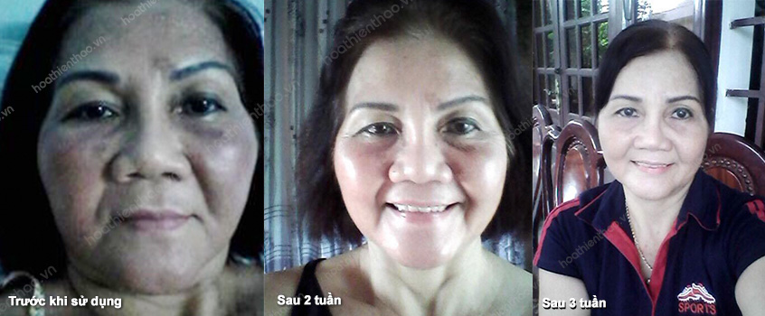 Da chị thắm cải thiện rõ rệt chỉ sau 3 tuần