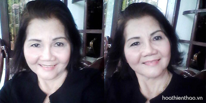 Nám lâu năm hết hẳn, trẻ hơn 10 tuổi nhờ chọn đúng phương pháp trị nám