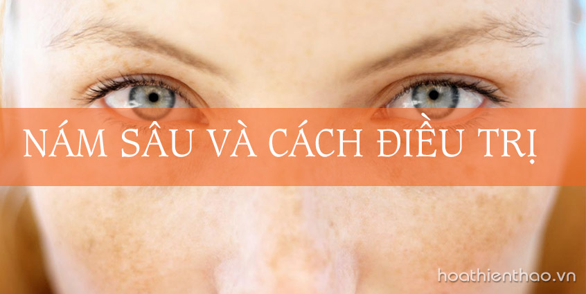 Nám sâu là gì? Làm thế nào để trị dứt điểm?