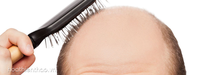 Nguy cơ hói đầu do rụng tóc ở nam giới