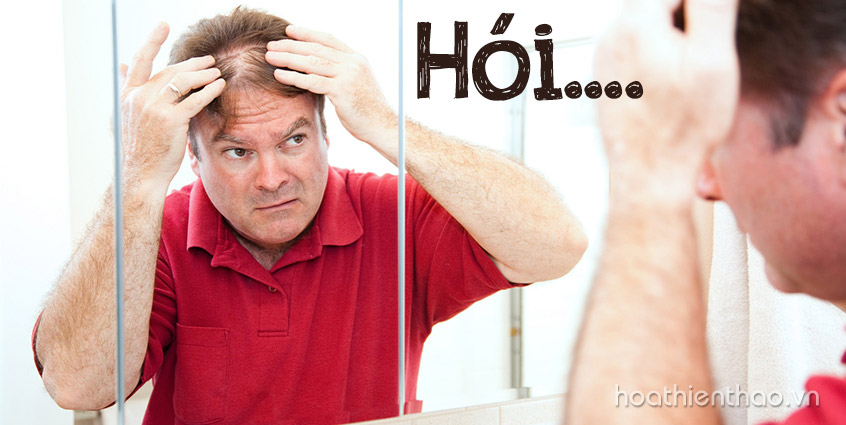 Nguy cơ hói đầu do rụng tóc ở nam giới