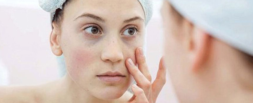 Nguyên liệu tự nhiên có giúp điều trị hết nám - Hoa Thiên Thảo
