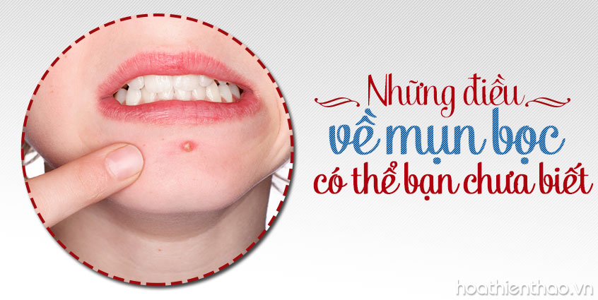 Những điều về mụn bọc có thể bạn chưa biết