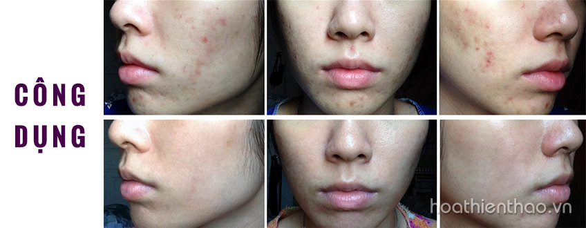 Review kem trị mụn được bác sĩ khuyên dùng - Rugby Acne 10%