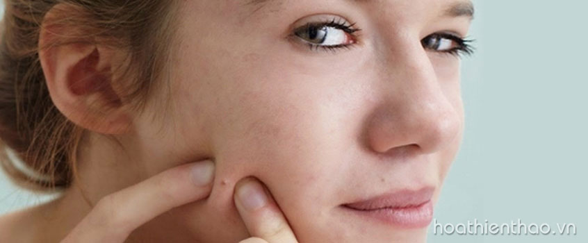 Tác hại khi chăm sóc da mụn sai cách