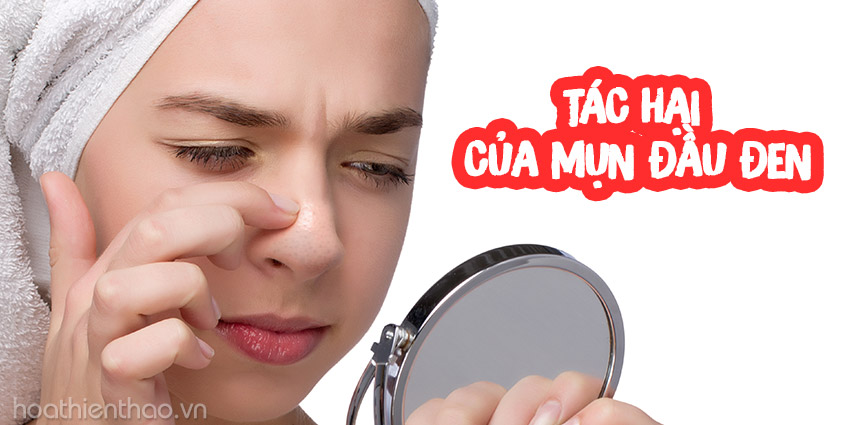 Tác hại không ngờ của mụn đầu đen