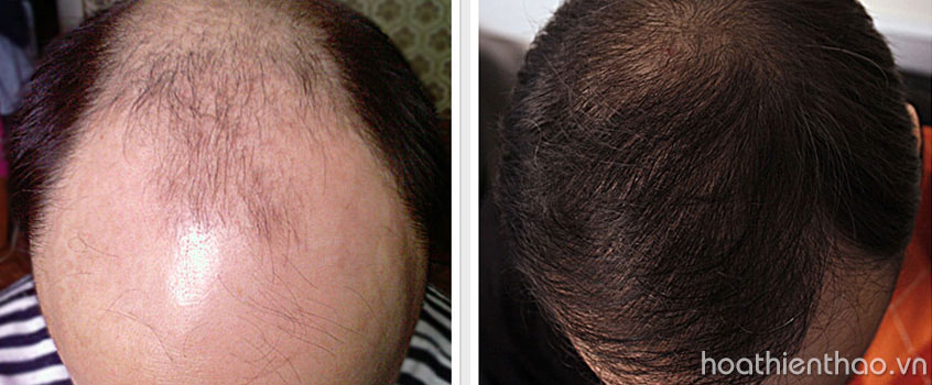 Kết quả trước và sau khi sử dụng viên uống mọc tóc Hair Gain