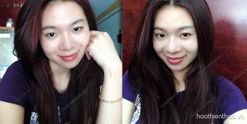 Làn da chị Hằng trở nên khỏe mạnh, trắng mịn không còn thâm mụn sau 1 tháng dùng kem Koee Pro