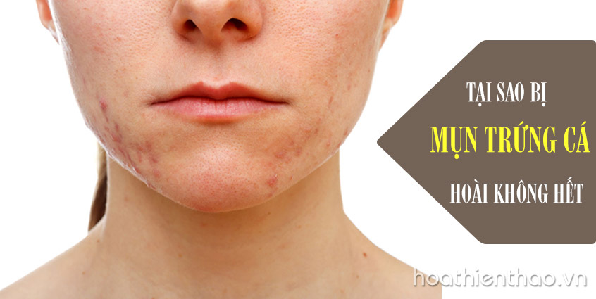 Mụn trứng cá trị hoài không dứt? Nguyên nhân vì sao?