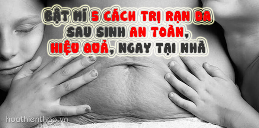 5 cách trị rạn da sau sinh An Toàn Hiệu Quả - Hoa Thien Thao