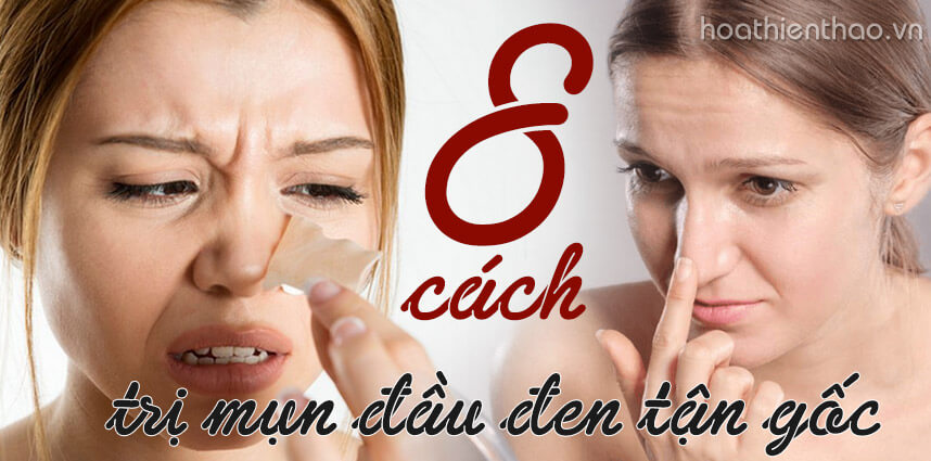 Bỏ túi 8 cách trị mụn đầu đen ở mũi tận gốc - Hoa Thiên Thảo