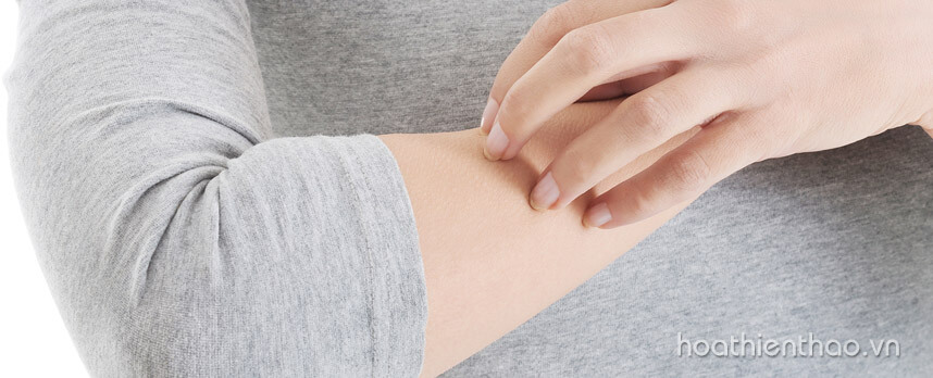 Bị ngứa da toàn thân vào mùa hè - Nguyên nhân và cách khắc phục - Hoa Thiên Thảo