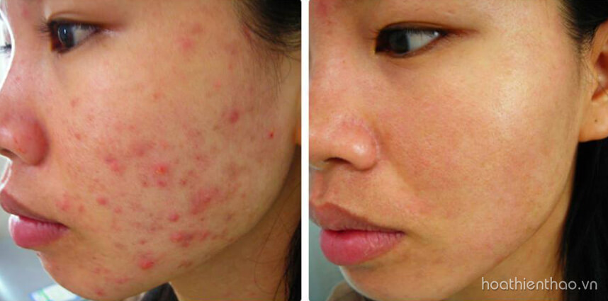 Bôi dầu gấc qua đêm có tốt không - HoaThienThao