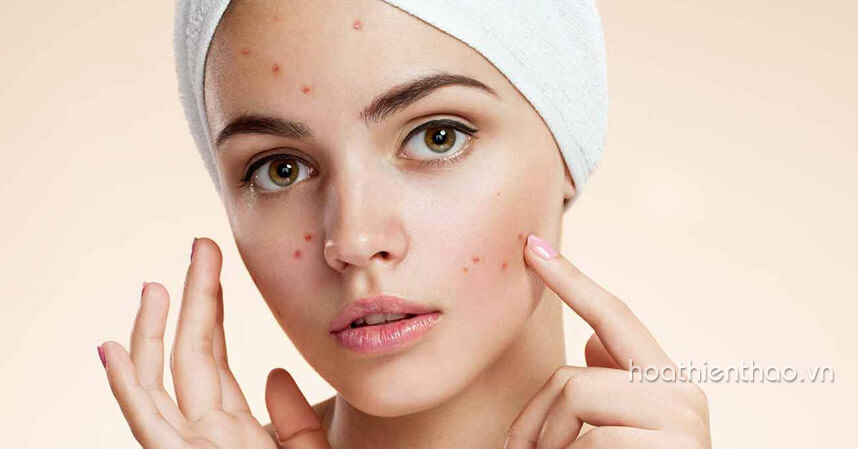 Các cách trị mụn bọc tại nhà nhanh nhất - Hoa Thiên Thảo