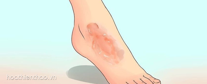 Cách lựa chọn kem trị sẹo bỏng tốt nhất hiện nay - Hoa Thiên Thảo