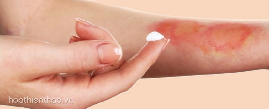 Cách lựa chọn kem trị sẹo bỏng tốt nhất hiện nay - Hoa Thiên Thảo