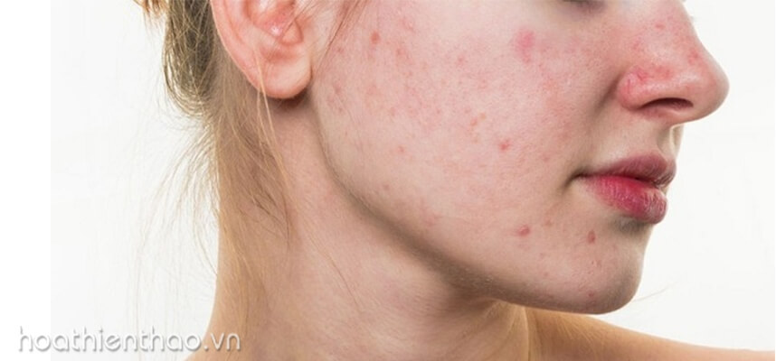 Cách phục hồi da sau mụn - HoaThienThao