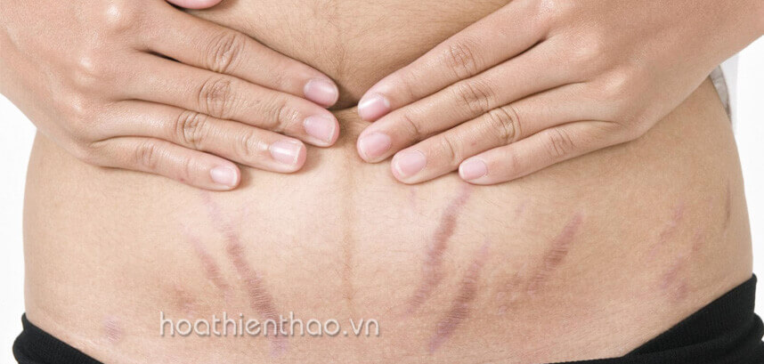 Cách phục hồi da sau sinh - HoaThienThao