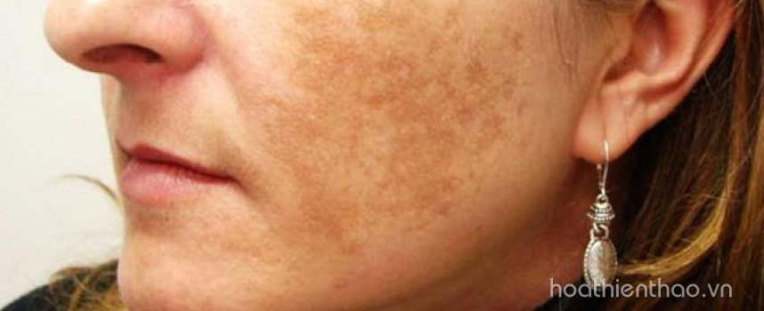 Chia sẻ câu chuyện trị nám thực tế từ một cô gái hiện đại - Hoa Thiên Thảo