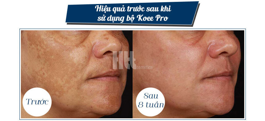 Công thức nghệ ngâm rượu trị nám hiệu quả - Hoa Thiên Thảo