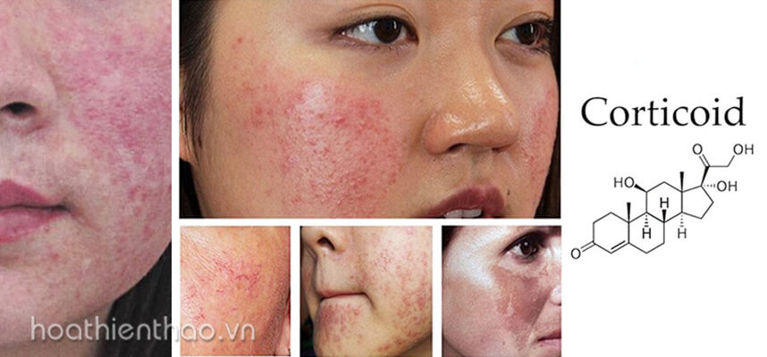 Da nhiễm Corticoid có chữa được không - HoaThienThao