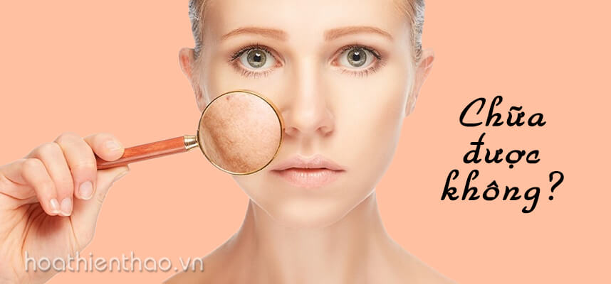 Da nhiễm Corticoid có chữa được không - HoaThienThao