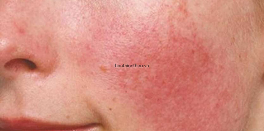 Da nhiễm Corticoid nên dùng gì - HoaThienThao