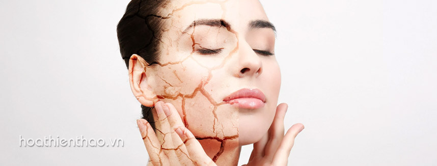 Da nứt nẻ vào mùa đông - Hoa Thien Thao Cosmetics