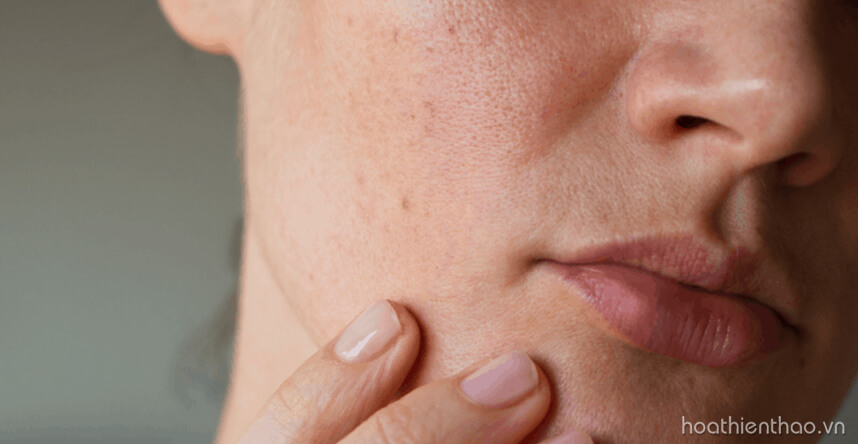 Dưỡng ẩm cho da khô nhạy cảm - HoaThienThao